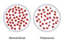 Thalassemia.png