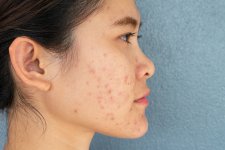 cicatrices-acne-comment-retrouver-une-belle-peau.jpg