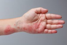 shingles-zoster-herpes-الجزام-الناري.jpg