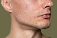 حب-الشباب-acne.jpg