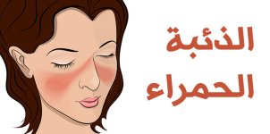 الذئبة-الحمراء.jpg